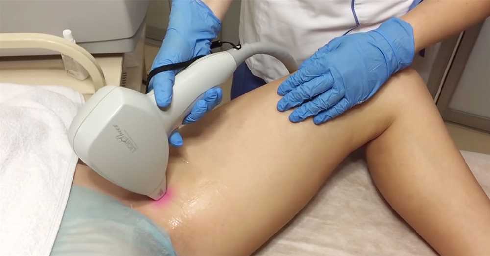 Преимущества шугаринга