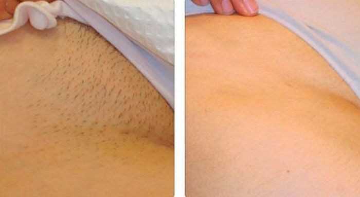 Преимущества и недостатки электролиза бикини