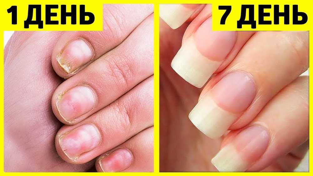 Как укрепить ногти с помощью правильного питания?