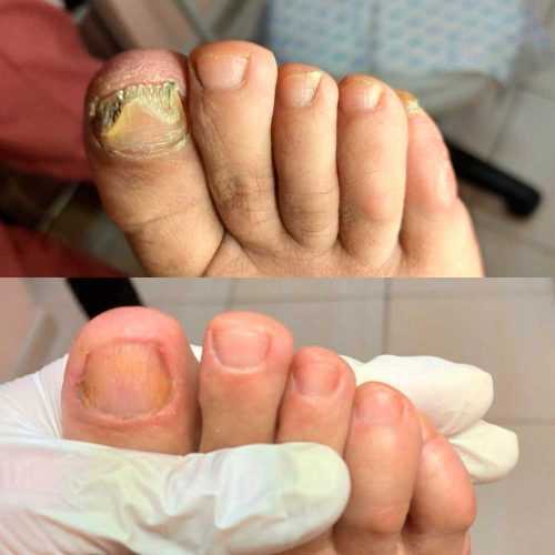  Как проходит процедура медицинского педикюра? 